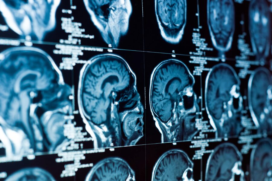 Brain Injury Lawyer